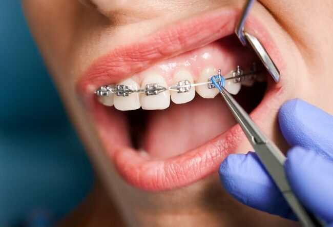Dentist placing braces on female patient teeth.