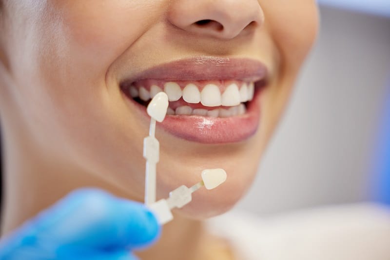 porcelain veneers